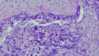 Ovarian blood test