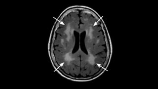 Age-related brain changes influence recovery after stroke