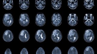 New grant funds first-of-its-kind gene therapy to treat aggressive brain cancer